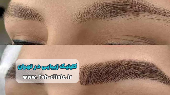 بهترین کلینیک زیبایی تهران برای کاشت مو و ابرو